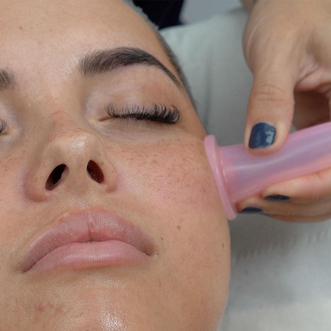 Facial cupping set 5 stuks